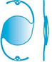 capsular ring